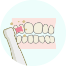 歯のクリーニングと使用法説明